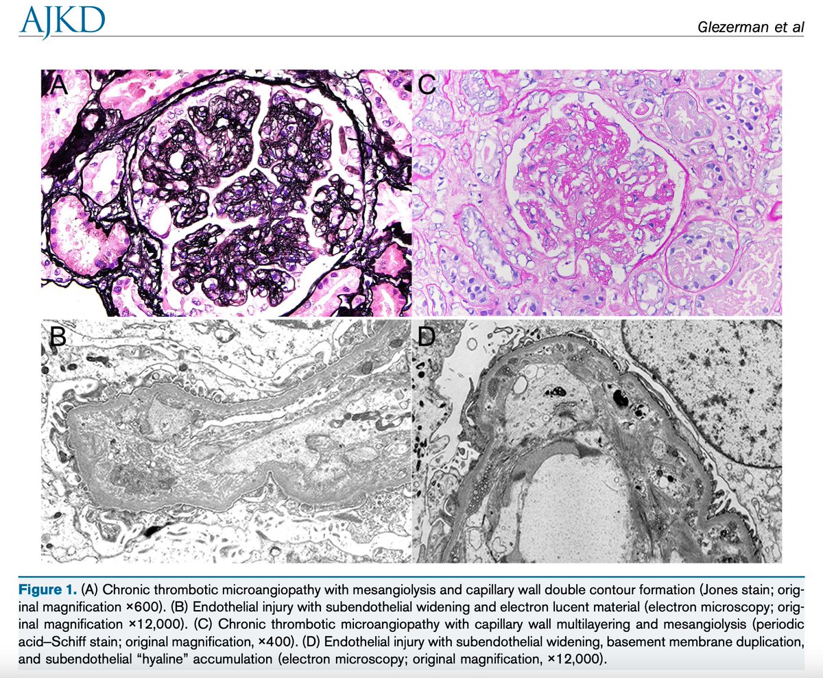 Pegylated Liposomal Doxorubicin Causes Kidney-limited Thrombotic Microangiopathy buff.ly/3FJSMKX @IlyaGlezerman @drstevesalvo @WTapMD @aishaikh @MSK_Neph