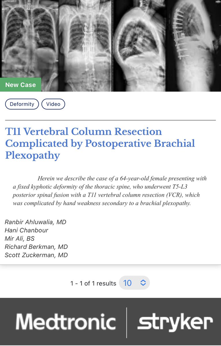 T11 VCR complicated by postoperative Brachial Plexopathy. Check out our new <a href="/VUMCSpine/">VUMCSpine</a> NEXUS case. <a href="/ScottZuck/">Scott Zuckerman, MD, MPH</a> <a href="/HaniChanbour/">Hani Chanbour MD</a>
