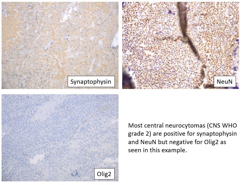 Central Neurocytoma (CNS WHO grade 2)