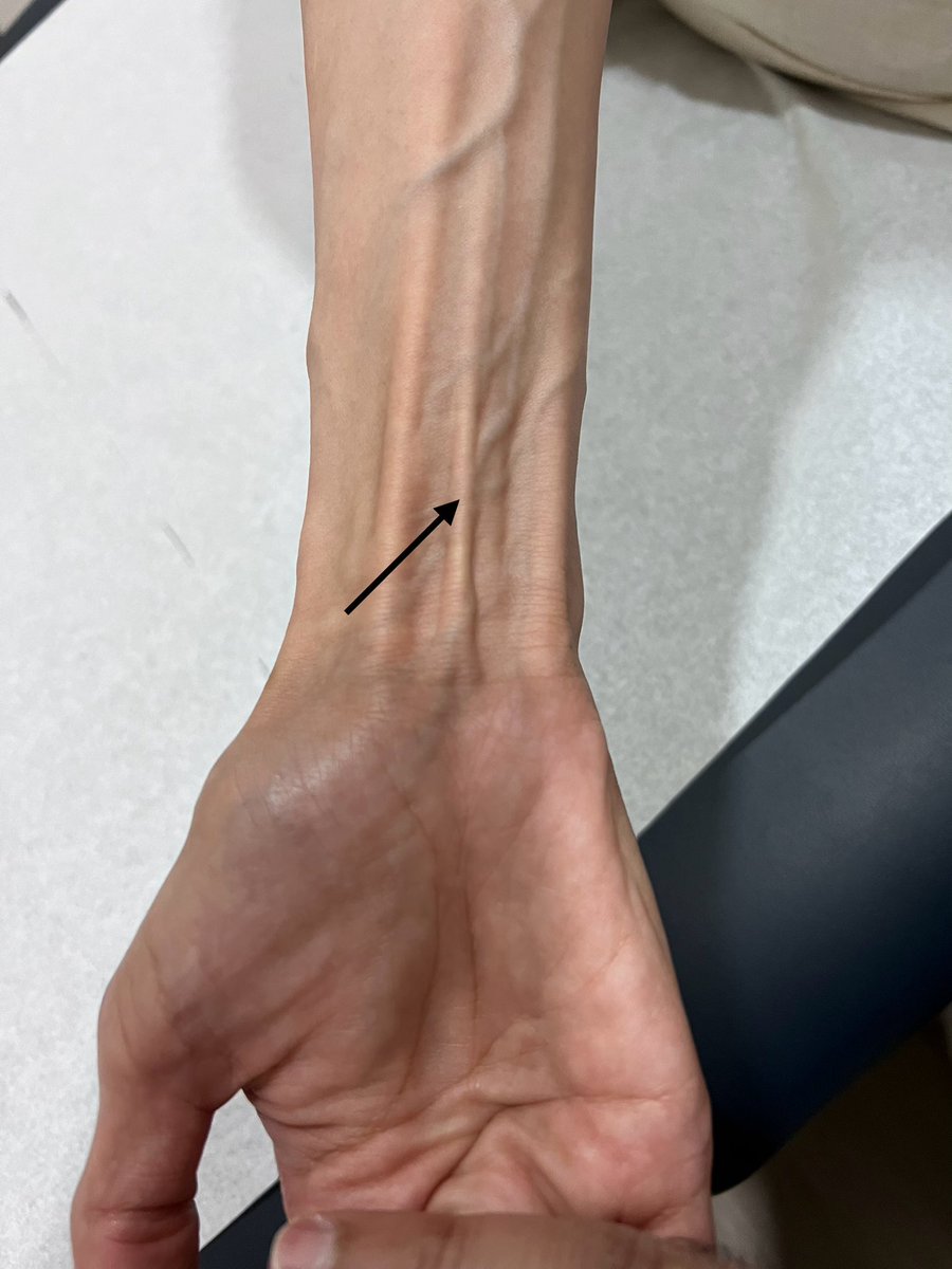 DrAlrwaily's tweet photo. اليوم جاني مريض عنده عضلة زايدة.

العضلة الزايدة اسمها Palmaris longus.

العضلة غير موجودة عند حوالي ٤٠٪ من الناس.

——
لن تجد دكتور يعد عضلاتك مثلي.

تعال عندي أعد عضلاتك وأعلمك وش الناقص وش اللي يبي له تصليح https://t.co/RP5YL56q8t