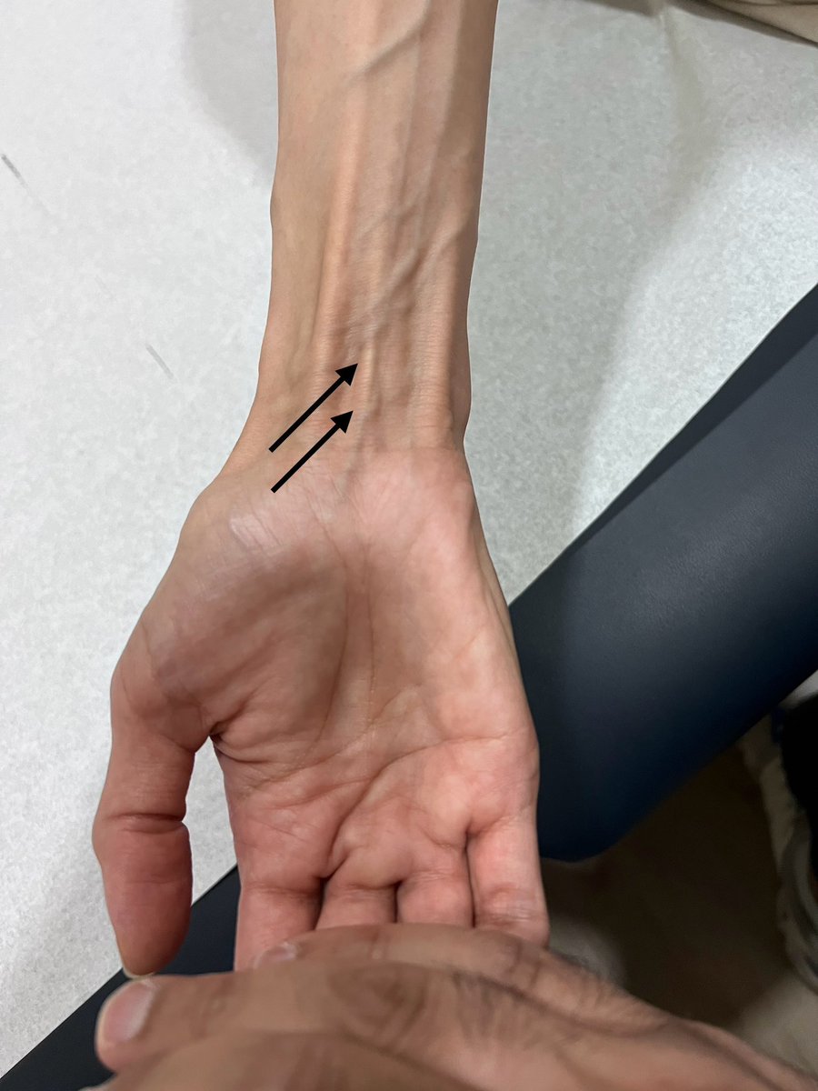DrAlrwaily's tweet photo. اليوم جاني مريض عنده عضلة زايدة.

العضلة الزايدة اسمها Palmaris longus.

العضلة غير موجودة عند حوالي ٤٠٪ من الناس.

——
لن تجد دكتور يعد عضلاتك مثلي.

تعال عندي أعد عضلاتك وأعلمك وش الناقص وش اللي يبي له تصليح https://t.co/RP5YL56q8t