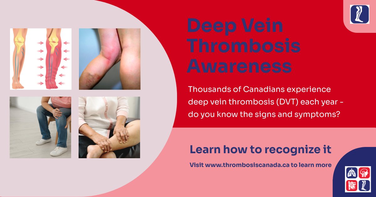ThrombosisCan's tweet photo. Know the Signs of DVT! This #DVTawarenessMonth, be alert for swelling, pain, and redness in your leg. Early detection is crucial! For more info, visit Thrombosis Canada website: https://t.co/HJyNUiwibo #StopDVT https://t.co/moYssJ0sY7