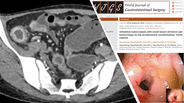 Ileal tuberculosis presenting as melena