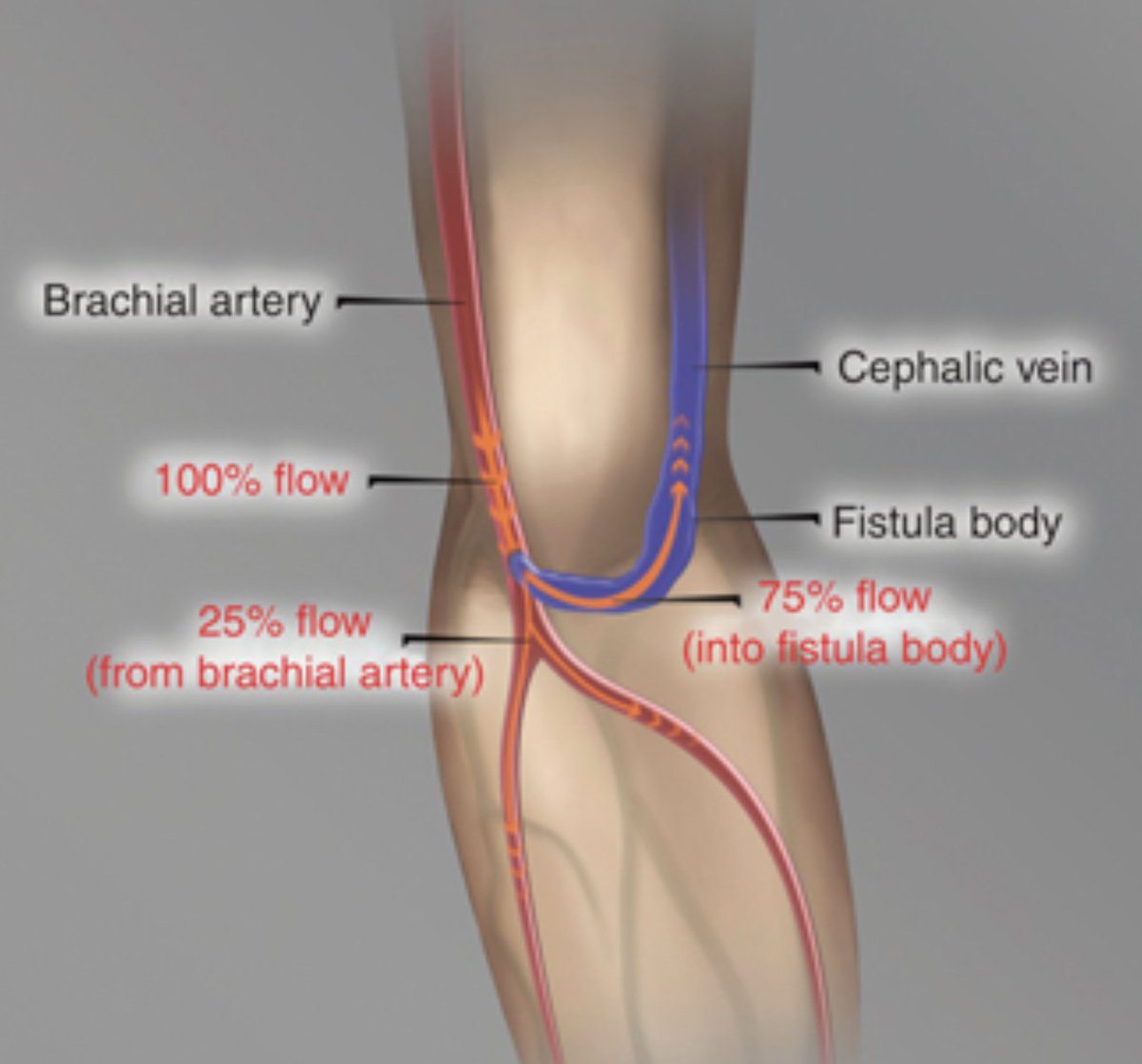 BehindTheKnife (@behindtheknife) on Twitter photo Clinical Challenges in Vascular Surgery: Dialysis Associated Steal Syndrome
Our <a href="/UMichSurgery/">Michigan Surgery</a> vascular team "steals" the show yet again. Join <a href="/DrewBraetMD/">Drew J Braet</a> <a href="/DSchechtmanMD/">David Schechtman</a> Dr. Bobby Beaulieu for great conversation.
🎧 app.behindtheknife.org/podcast/clinic… 🎧 Clinical Challenges in Vascular Surgery: Dialysis Associated Steal Syndrome
Our <a href="/UMichSurgery/">Michigan Surgery</a> vascular team "steals" the show yet again. Join <a href="/DrewBraetMD/">Drew J Braet</a> <a href="/DSchechtmanMD/">David Schechtman</a> Dr. Bobby Beaulieu for great conversation.
🎧 app.behindtheknife.org/podcast/clinic… 🎧