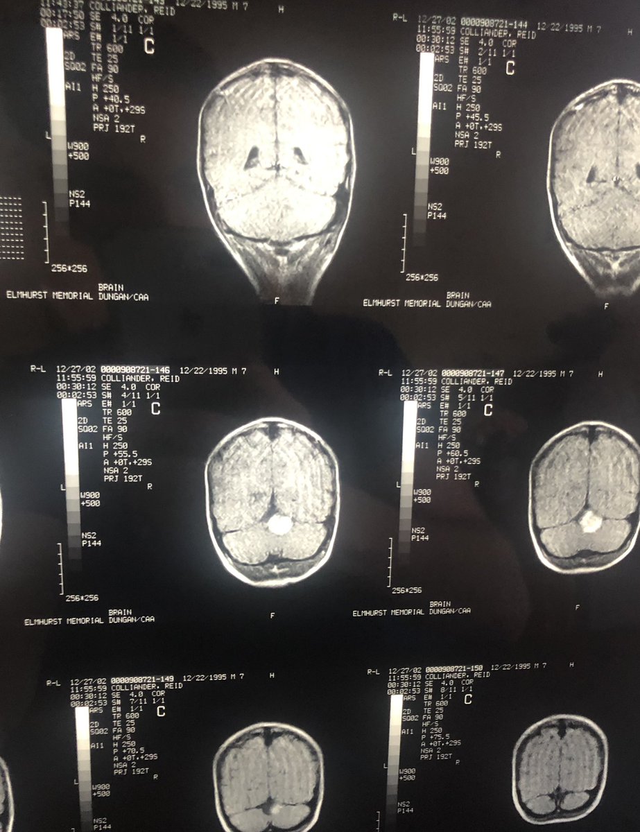 ReidColliander's tweet image. 21 years later we have finally come full circle. I’m going to be a neurosurgeon!! 

#Match2024 #Neurosurgery