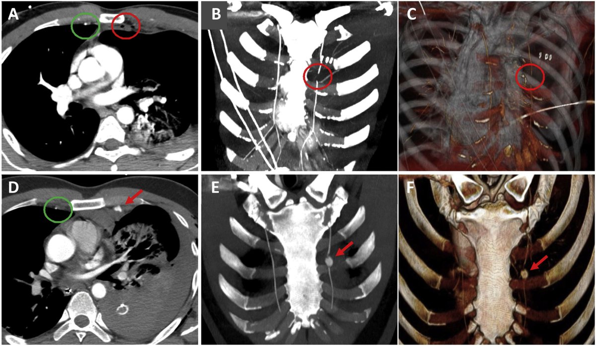 RevistaRADIOLO2's tweet image. No te pierdas las impresionantes imágenes de este artículo sobre el traumatismo torácico grave no cardiovascular. ¡Un repaso completo! @AnaVillanuevaCa @SEICAT_RAD 
elsevier.es/es-revista-rad…
Link to the English version
elsevier.es/en-revista-rad…