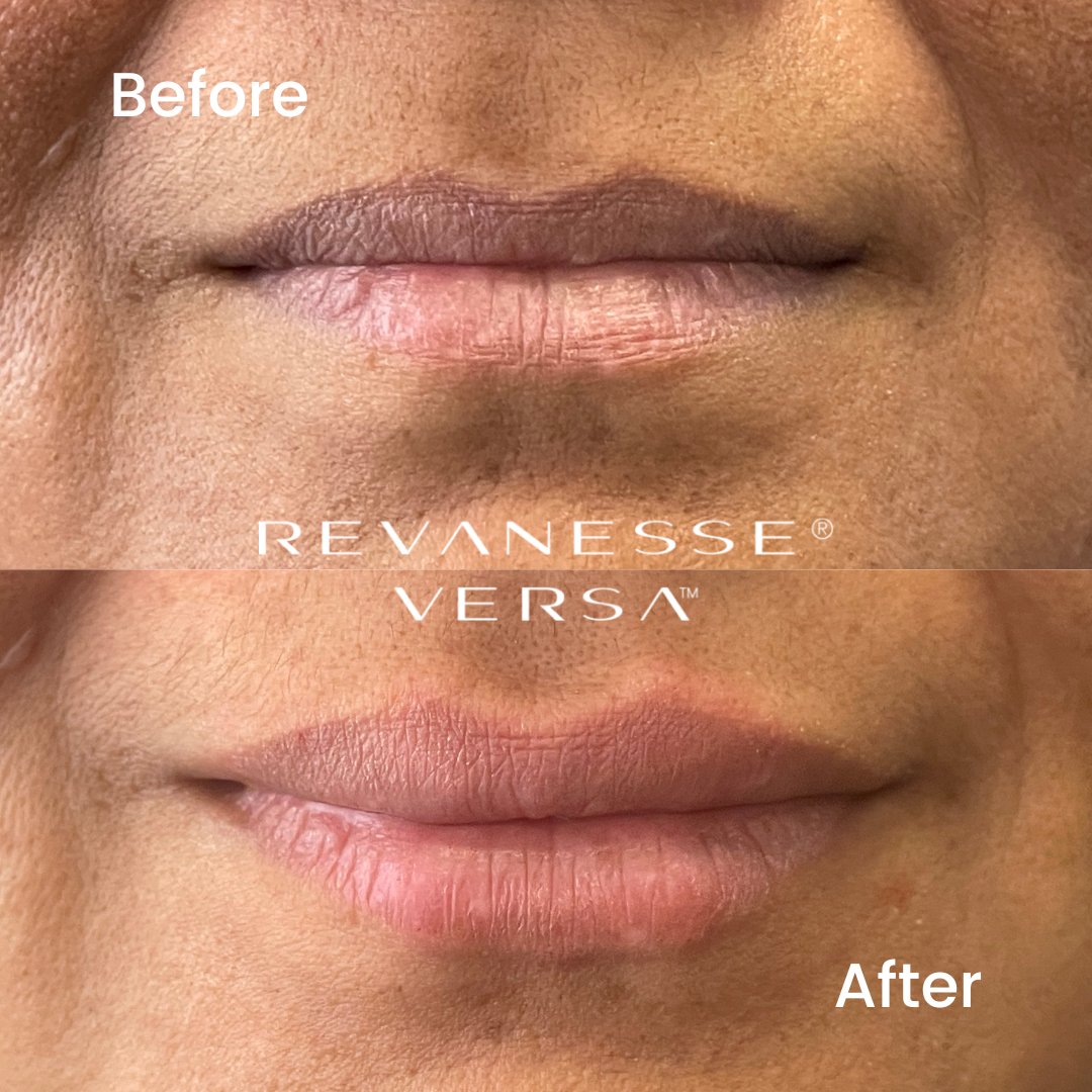 medspaofhouston's tweet photo. Try the Newer, Versatile Dermal Filler
REVANESSE VERSA
$349 for one syringe (1.2mL)
Contact us to claim your spot before this promotion ends!👇
#RevanesseVersa #DermalFiller #Revanesse #Smarttox #Smarttoxin #MedspaOfHouston #Medspa #Houston #beforeandafter https://t.co/X0J3gNeuim