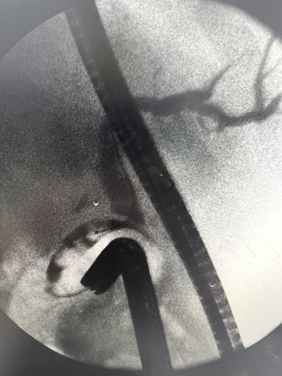 aitt21's tweet photo. @DouglasAdlerMD Nice picture… This one was interesting too. 
ERCP always a challenge! https://t.co/SjFsxgyGZP