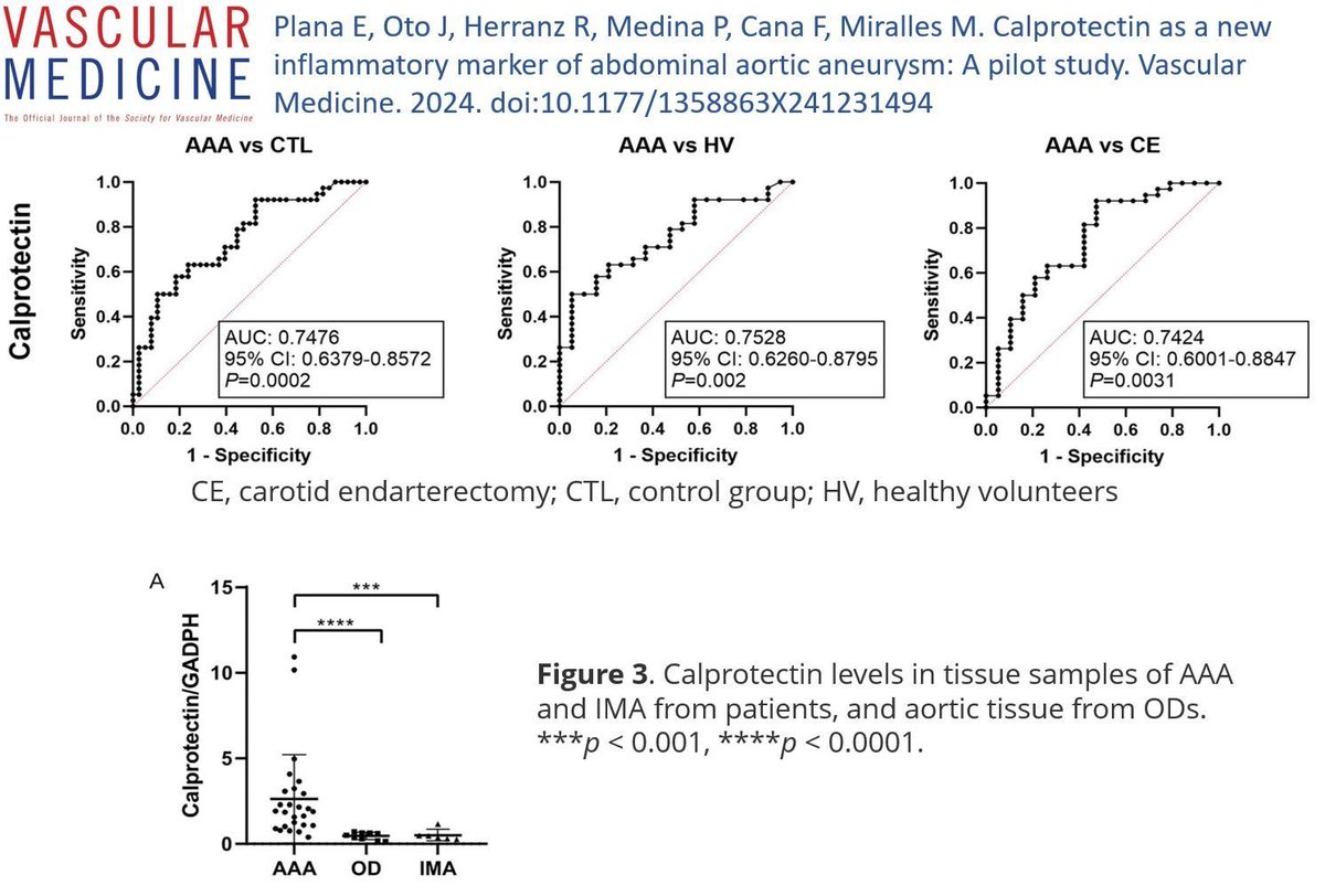 Online First! Plana et al. find elevated levels of calprotectin, a cytoplasmic neutrophil protein, in the arterial wall and circulating plasma of patients with abdominal aortic aneurysms. Read more at buff.ly/48OwhRa