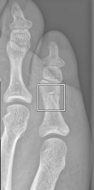 monoespacial_yt's tweet photo. Well, turns out I broke my pinky toe accidentally banging it against the dishwasher.
#rippinkytoe #pinkytoelife https://t.co/TVgfTpNiGG