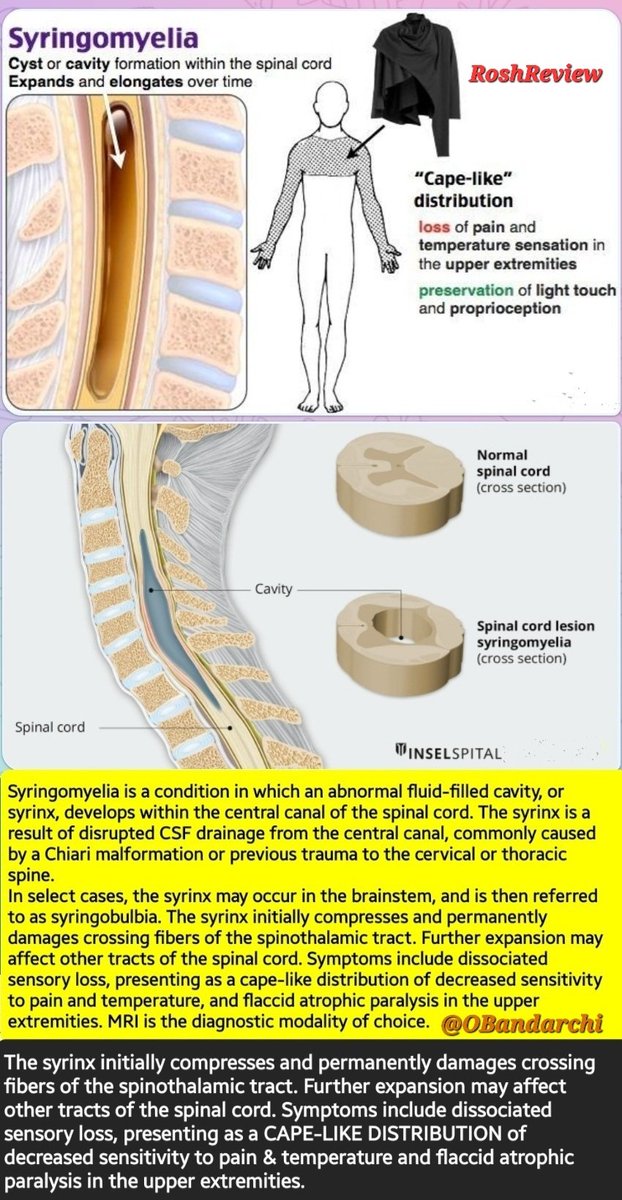 Syringomyelia Spinal Cord Cross Section