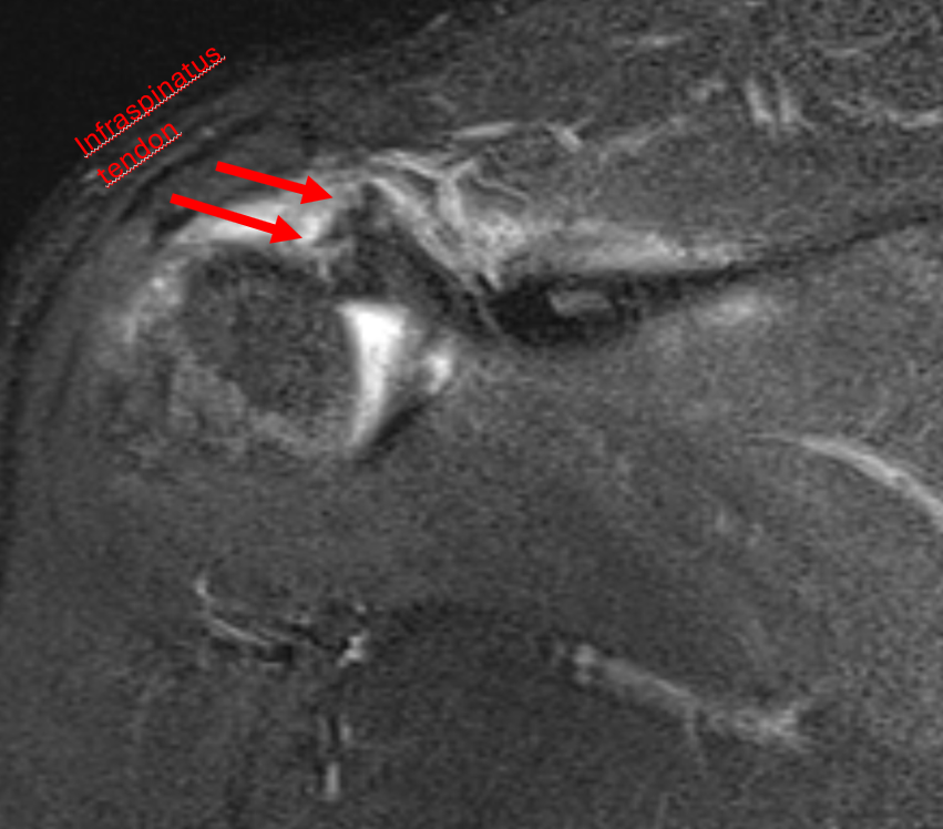 Something is missing ... Greater tuberosity avulsion fracture. Concave well defined defect superolateral margin of humeral head. T1 imaging reveals bone fragment attached to Supra and infra tendons, with displacement and retraction. #shoulder #msk #mskrad