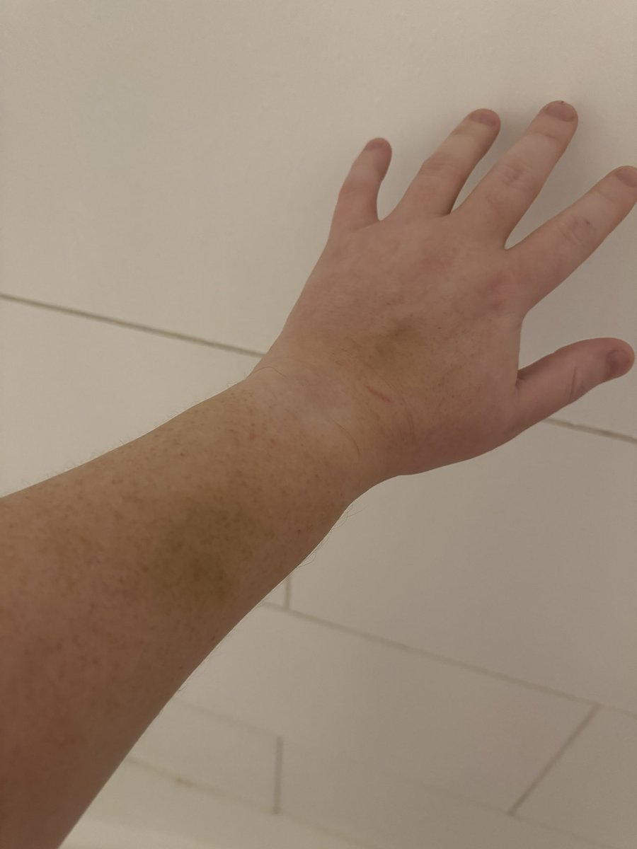 CagedBearDTX's tweet photo. Going to the Doctor tomorrow and trying to figure out how I can explain or hide the bruises from prison fights without them thinking I’m a victim of DV lol
#prisonfights #inmate #incarceration #bruises #convict #doctor https://t.co/irAocfIb86