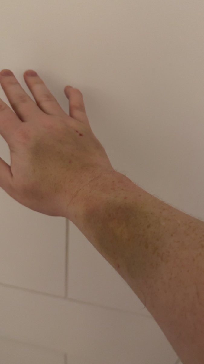 CagedBearDTX's tweet photo. Going to the Doctor tomorrow and trying to figure out how I can explain or hide the bruises from prison fights without them thinking I’m a victim of DV lol
#prisonfights #inmate #incarceration #bruises #convict #doctor https://t.co/irAocfIb86