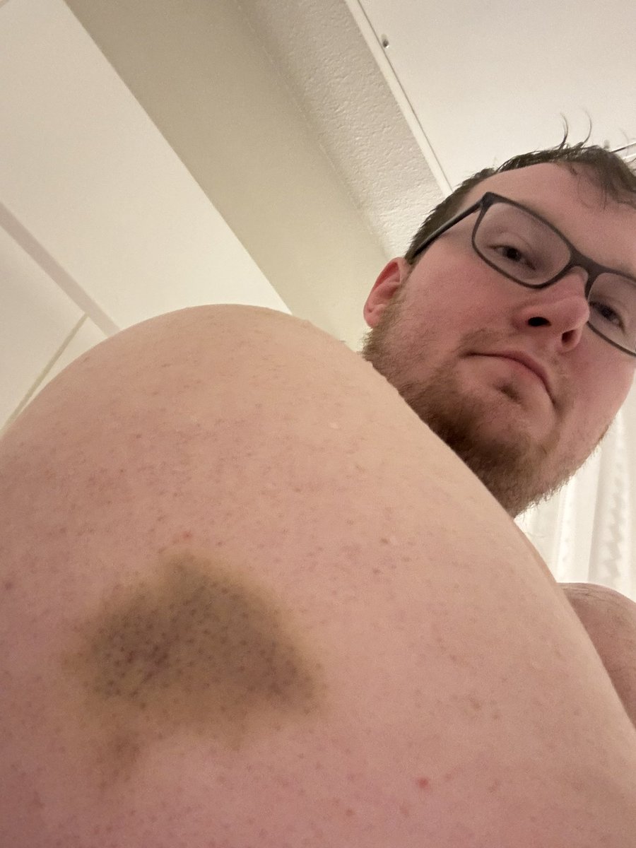 CagedBearDTX's tweet photo. Going to the Doctor tomorrow and trying to figure out how I can explain or hide the bruises from prison fights without them thinking I’m a victim of DV lol
#prisonfights #inmate #incarceration #bruises #convict #doctor https://t.co/irAocfIb86