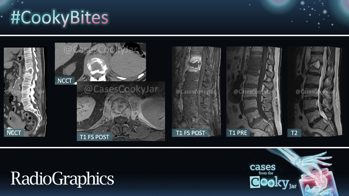 60-year-old man with a history of prolonged back pain, now with new onset of low-grade fever. What is the diagnosis❓ We’ll post the answer in 24h. Share companion cases with us using #CookyBites #154. We will RT the best cases! #RGphx @cookyscan1 @RadioGraphics