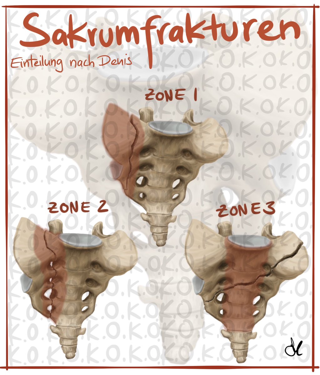 #trauma #unfallchirurgie #medicine #medicalart #MedTwitter #TraumaTwitter #medicalillustration #illustration #anatomy #sacrum #fracture #digitalart #procreate #ota #classification #learning #study #learningbydrawing