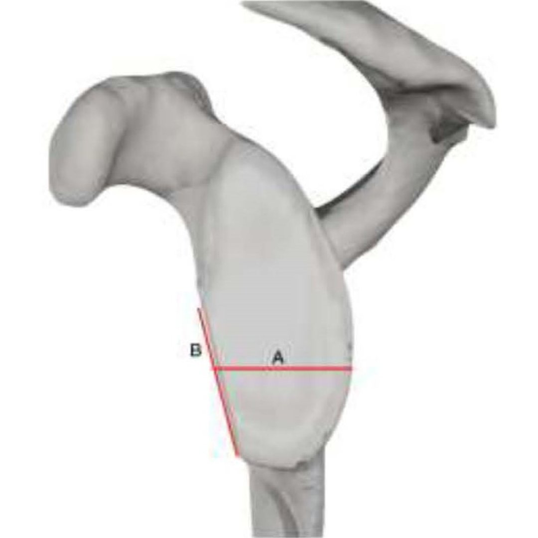 Bone & Joint Open (@bonejointopen) on Twitter photo No ideal CT-based method is demonstrated in the current literature, however evidence suggests that surface area methods are more reproducible & lead to fewer over-estimations of bone loss.
#Surgeons #BJO #MRI @duncantennent <a href="/OrthoGeorgePods/">St. George's Orthopods</a>
ow.ly/6UUQ50QLvYU No ideal CT-based method is demonstrated in the current literature, however evidence suggests that surface area methods are more reproducible & lead to fewer over-estimations of bone loss.
#Surgeons #BJO #MRI @duncantennent <a href="/OrthoGeorgePods/">St. George's Orthopods</a>
ow.ly/6UUQ50QLvYU