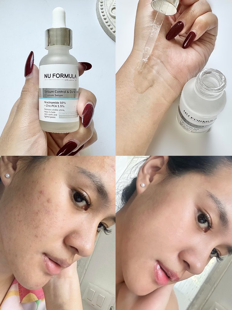 เจอตัวจบปัญหากวนใจต้อง NU FORMLA แอมพลูเซรั่มลดผิวมัน และรอยสิว ตอบโจทย์คนหน้ามัน มีรอยสิวแบบเรา คือเห็นผลตั้งแต่ 7 วันแรก เนื้อเซรั่มใส ซึมไว ใช้แล้วความมันลดลง รอยสิวจางลง ใช้ตัวนี้ต่อยาวๆ #ใช้ดีบอกต่อ 

พิกัดสั่งซื้อ: bit.ly/3SD3n0i