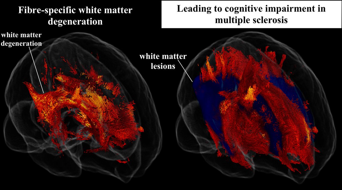 @BrainComms (@braincomms) on Twitter photo Koubiyr et al. report white matter (WM) degeneration in #multiplesclerosis using a ‘fixel-based’ approach, which considers the full complexity of WM and shows higher sensitivity. <a href="/IsmailKoubiyr/">Koubiyr Ismail</a> <a href="/Mennoke/">Menno Schoonheim</a> shorturl.at/fzX12 Koubiyr et al. report white matter (WM) degeneration in #multiplesclerosis using a ‘fixel-based’ approach, which considers the full complexity of WM and shows higher sensitivity. <a href="/IsmailKoubiyr/">Koubiyr Ismail</a> <a href="/Mennoke/">Menno Schoonheim</a> shorturl.at/fzX12
