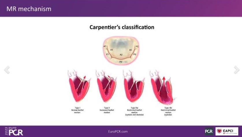 PCRonline Editor's Pick: All you need to know about transcatheter treatment solutions for mitral regurgitation Replay📺 pcronline.com/Cases-resource… What you will learn: 🟣various approaches and comparisons through three cases of #mitral regurgitation, 🟣fundamental aspects of…