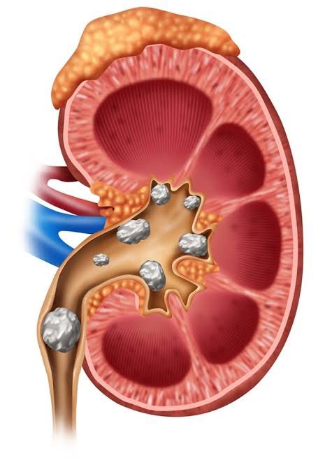 #Nephrology 🦠

“Which renal stone is radiolucent?

A) Calcium oxalate
B) Calcium phosphate
C) Uric acid
D) Struvite

#MedEd #Nephrology #MedicalTwitter'