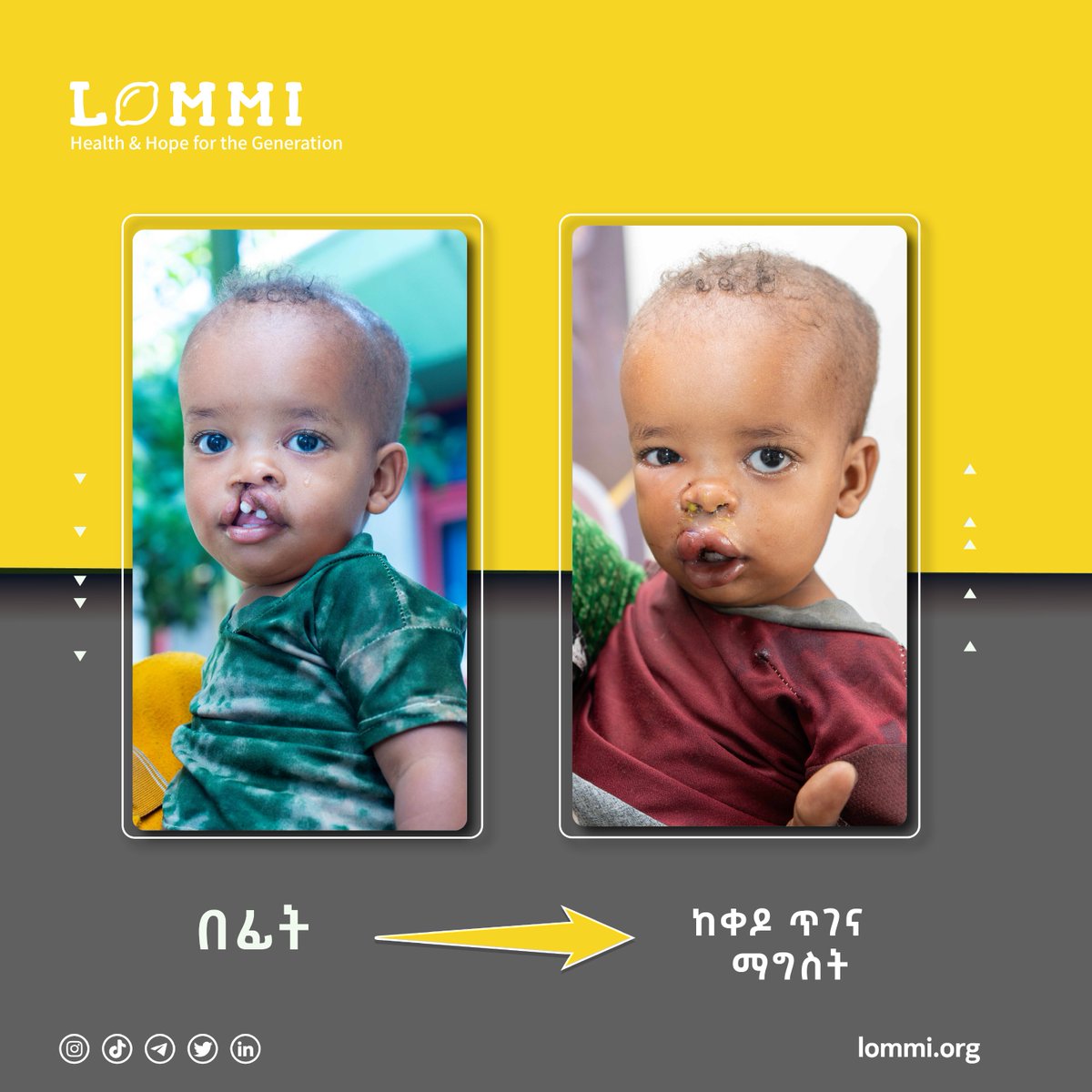 የከንፈር እና የላንቃ መሰንጠቅ ማስተካከያ ቀዶጥገና ሚያስፈልገው ሰው ያቃሉ?
ካወቁ ያንን ሰው ነጻ ህክምናውን እንዲያገኝ በማድረግ ይሸለሙ!

ለተጨማሪ መረጃ እና ለመመዝገብ
☎️☎️☎️0973025555 ላይ ይደወሉ!

🍋 🍋 🍋
lommi.org