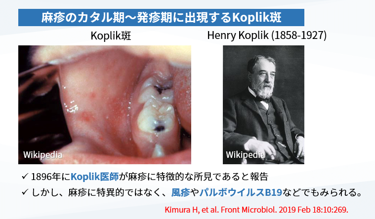 kekkakuJSTB's tweet photo. 麻疹の流行が話題ですが、カタル期に有用な所見として口腔内の「Koplik斑」があります。しかし、国内の大規模研究によると、麻疹例のうち約28％、風疹例のうち約17％にみられ、有用ではあるもののウイルス特異的とまでは言えないようです。 https://t.co/KkKyD72tUN