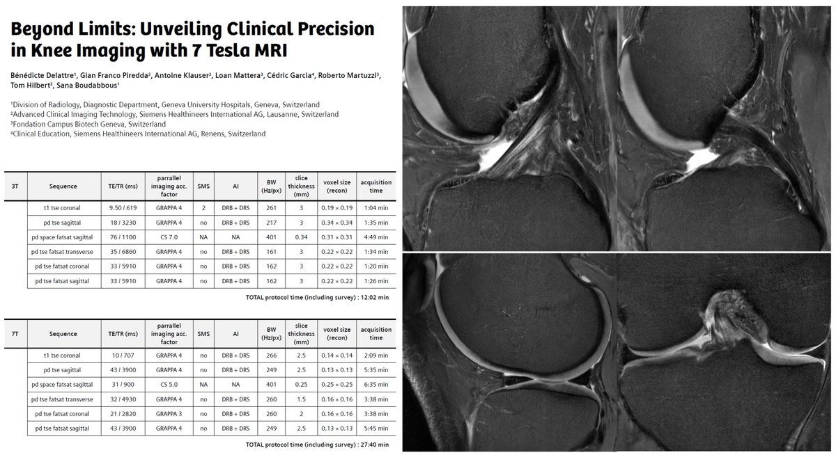 Beyond Limits: Unveiling Clinical Precision in Knee Imaging with 7 Tesla MRI by Sana Boudabbous, Bénédicte Delattre (Geneva University Hospitals, Switzerland), et al.
Learn more at …ng.webassets.siemens-healthineers.com/c69066f115702a…

#magnetomworld #MSK #7tmri <a href="/SiemensHealth/">Siemens Healthineers</a> #MRI #UHF