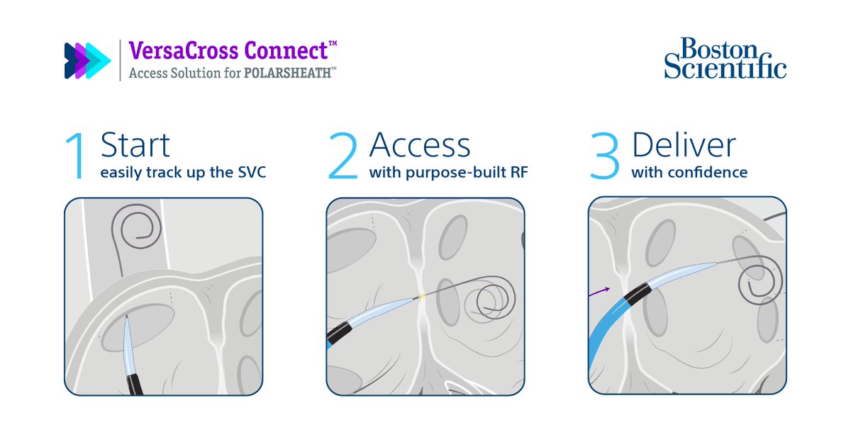 Experience and Workflow During Cryoablation Procedures Using the VersaCross Connect™ Access Solution for POLARSHEATH™ (Boston Scientific): Discussion With @DrBradleyKnight okt.to/AN2V3a @BSCCardiology