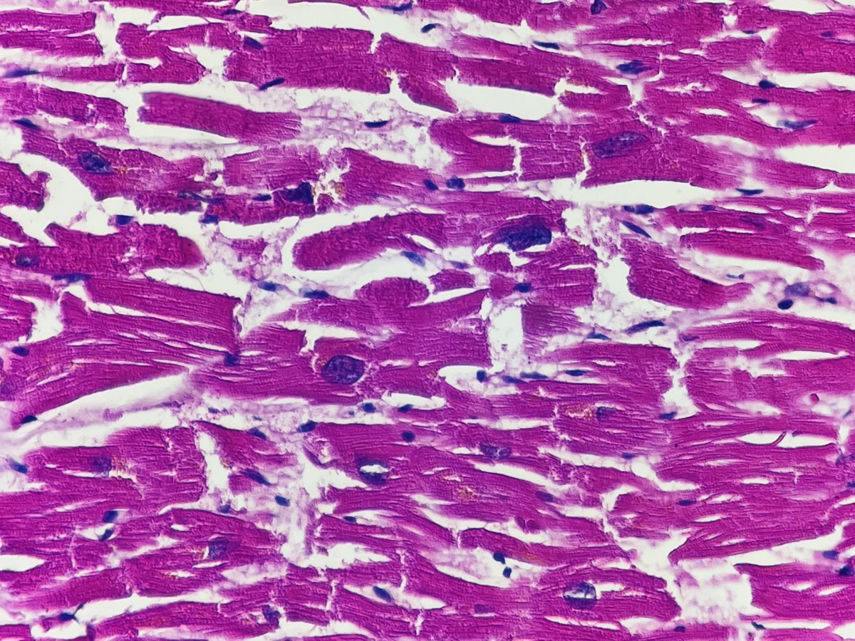 Pia_tejada7's tweet photo. Hipertrofia de miocardiocito 🫶🏻🫀 https://t.co/cHfA3RL3zz