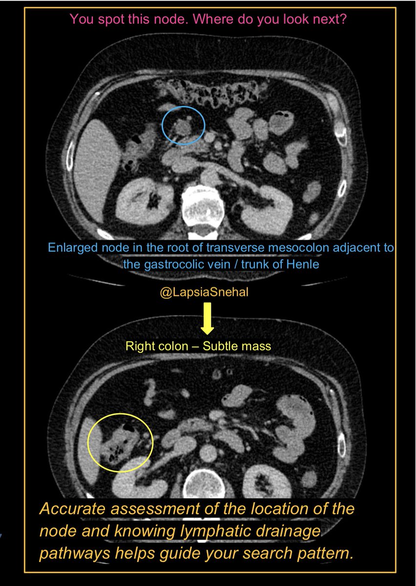 Knowing your lymphatic drainage pathways can be very useful ! #FOAMrad #FOAMed #meded #radres #futureradres #medstudenttwitter #gitwitter #anatomy #frcr #surgery #radiology #radtwitter #medtwitter #colorectal