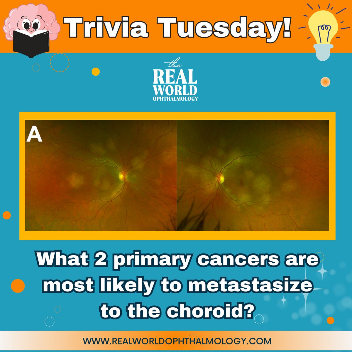 Happy #TriviaTuesday ‼️

What two primary cancers are most likely to metastasize to the choroid?🤔 (multiple choices are permitted)

A.Lung
B.Lymphoma
C.Breast 
D.Thyroid

Let us know your answer in the comments below! 😌

#OphthoTwitter #MedTwitter #Diagnosis