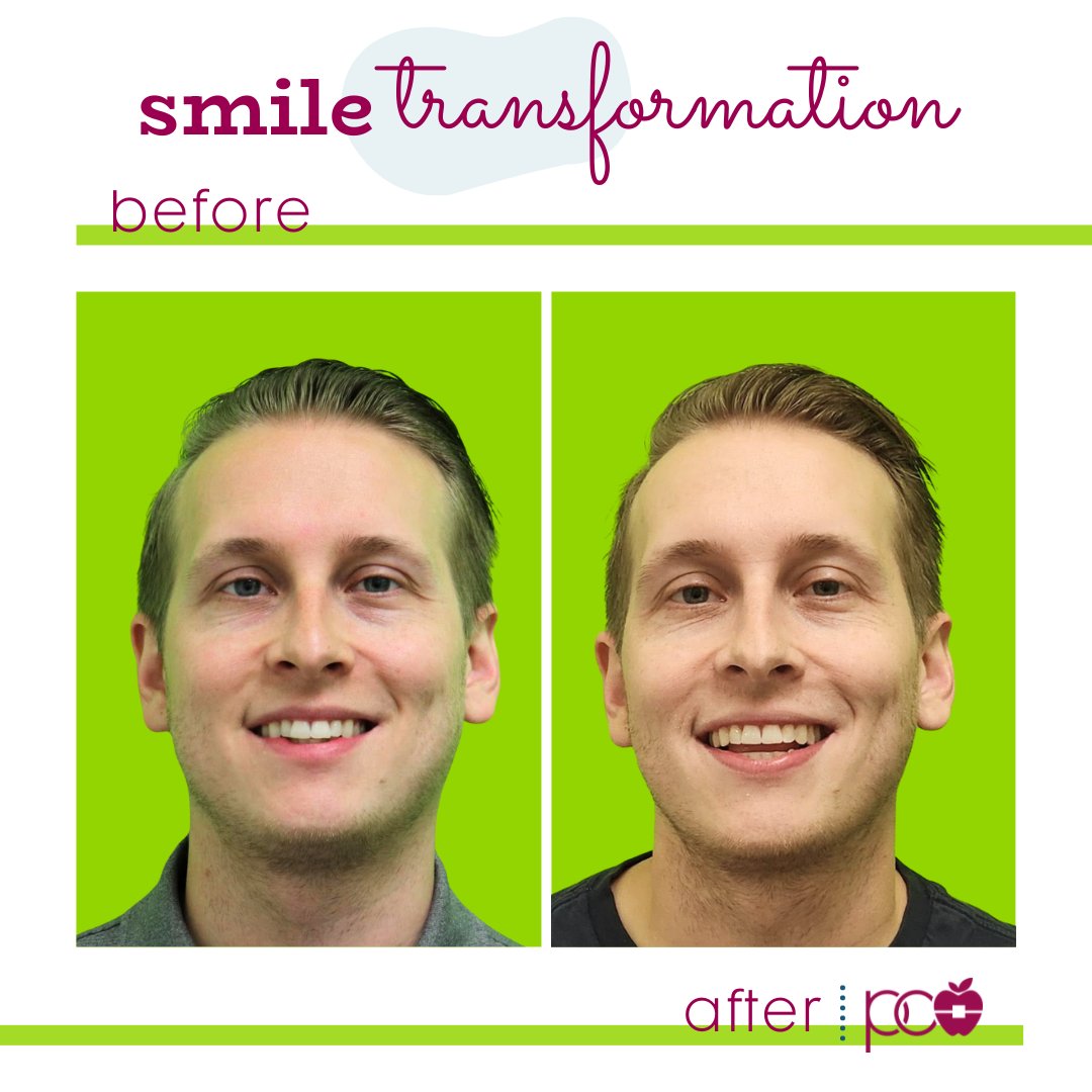 pinecrestortho's tweet photo. Happy ✨Transformation Tuesday✨! Check out the incredible results of Shawn's smile transformation, made possible by @Invisalign. His new smile looks amazing! 👏 🤩

#TransformationTuesday #NewSmile #Invisalign #Orthodontics #PinecrestFL https://t.co/b0ohs2okcF