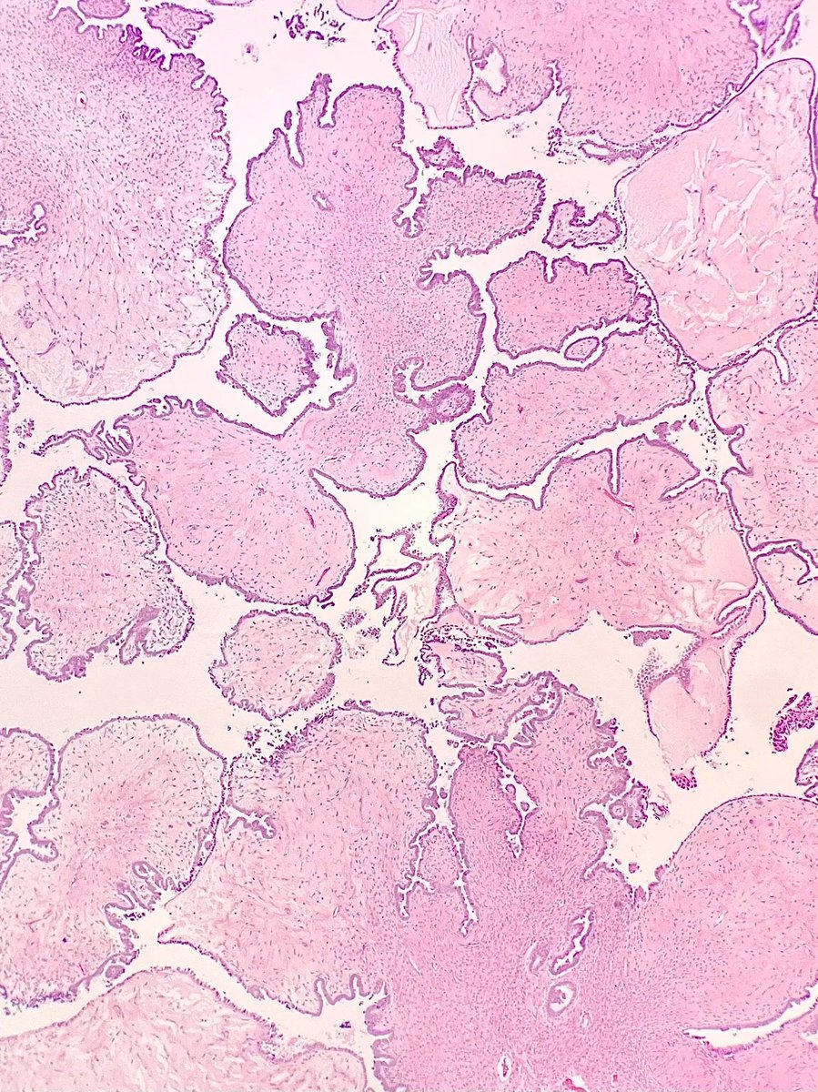 Oophorectomy specimen revealing what type of tumor? Answer: buff.ly/496SUBe    #PathArt #PathTwitter #MedTwitter
