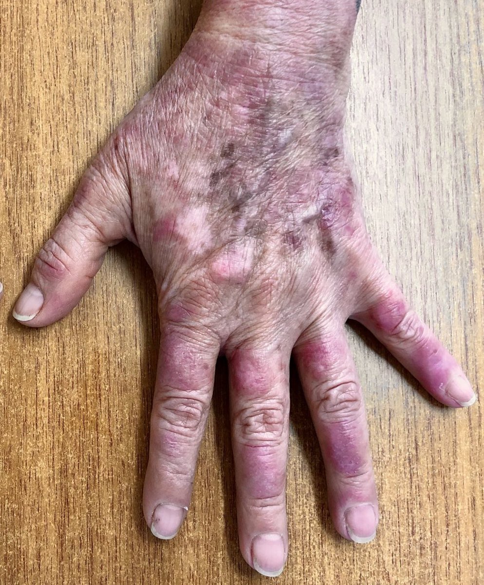 doctorchmunoz's tweet photo. Creo que parte de la belleza de la semiología reside en que nos permite separar hallazgos
superficialmente semejantes... que en realidad son completamente diferentes en su esencia mas pura👇🏻 Dermatomiositis vs Lupus https://t.co/OkfXdMOhmB