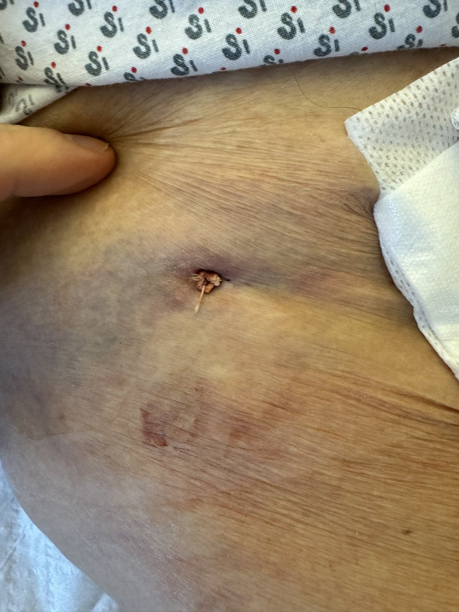 KardiologieHH's tweet photo. Patient presented in ER with:
„I'm afraid your colleagues have forgotten something in my groin“
⬇️
Diagnostic #CAG via #UnsafeFemoral in other hospital
⬇️
Collegues implanted an #AngioSeal 6F
This is how it looks like 📷
#HowWouldYouTreat❓ https://t.co/cJe7B9XH18