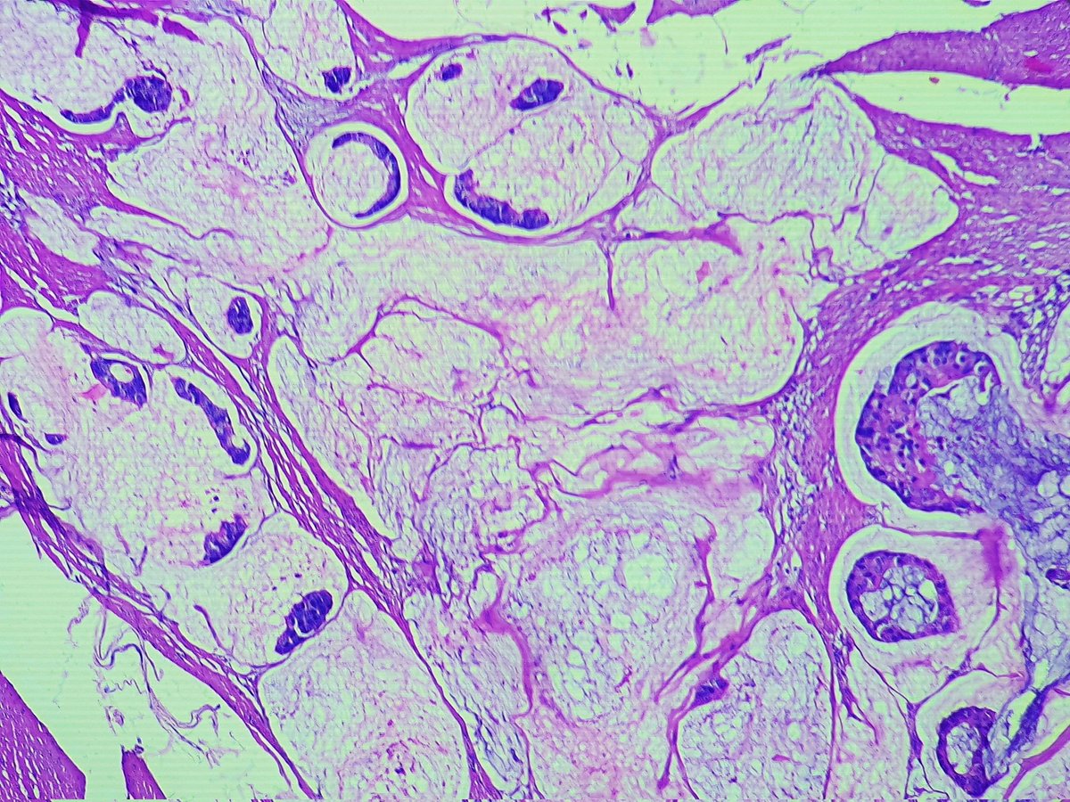 From a gastric mass. Thanks #PathMatch2024 #PathTwitter #pathology #pathoutpic