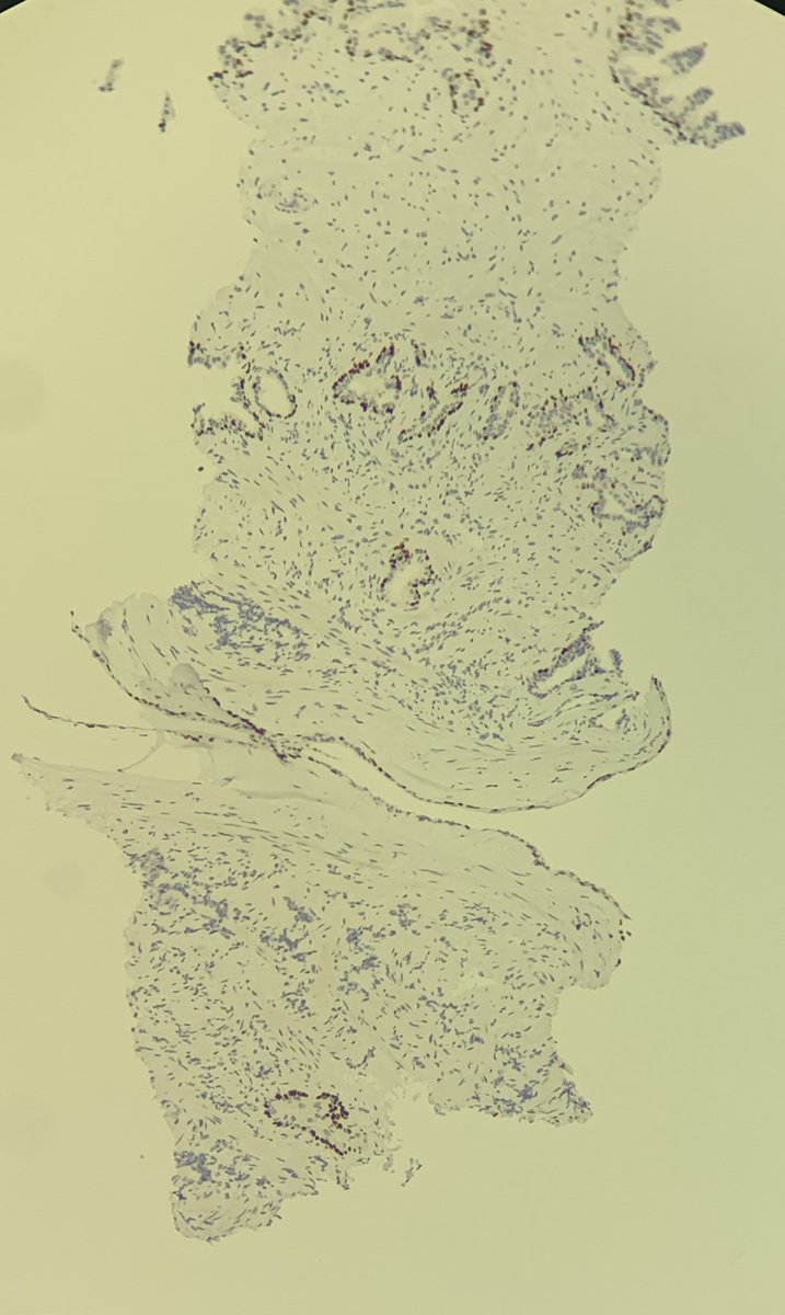 drparomitaroy's tweet photo. This is what cost efficiency without compromising quality looks like in #LMIC 
Ten cores of #prostatebiopsy on a single slide for p63 #IHC and control tissue! 
Hat’s off to our brilliant, hardworking #labtechnicians 
@IHC_guy @GU_Path_Society @IntSocUropath 
#BAUP #GUPath https://t.co/S0y9ljWs54