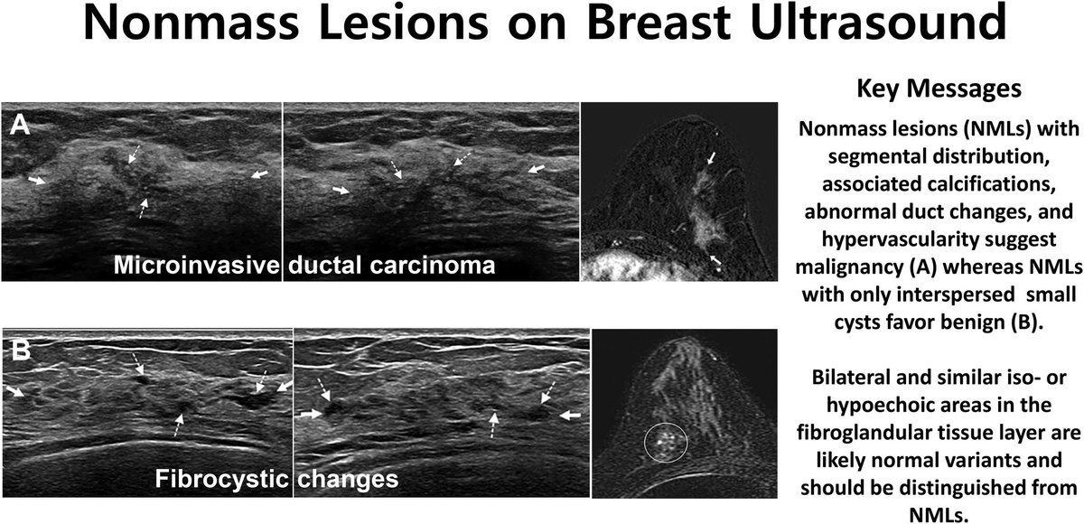 📢📢 LATEST #JBI Editor’s Choice Educational Review📢📢 Nonmass lesions (NMLs) on breast US: discrete areas of altered echotexture compared to surrounding breast tissue and lack the 3-dimensionality of a mass. Read more 👇🏻👇🏻👇🏻 academic.oup.com/jbi/article/6/…