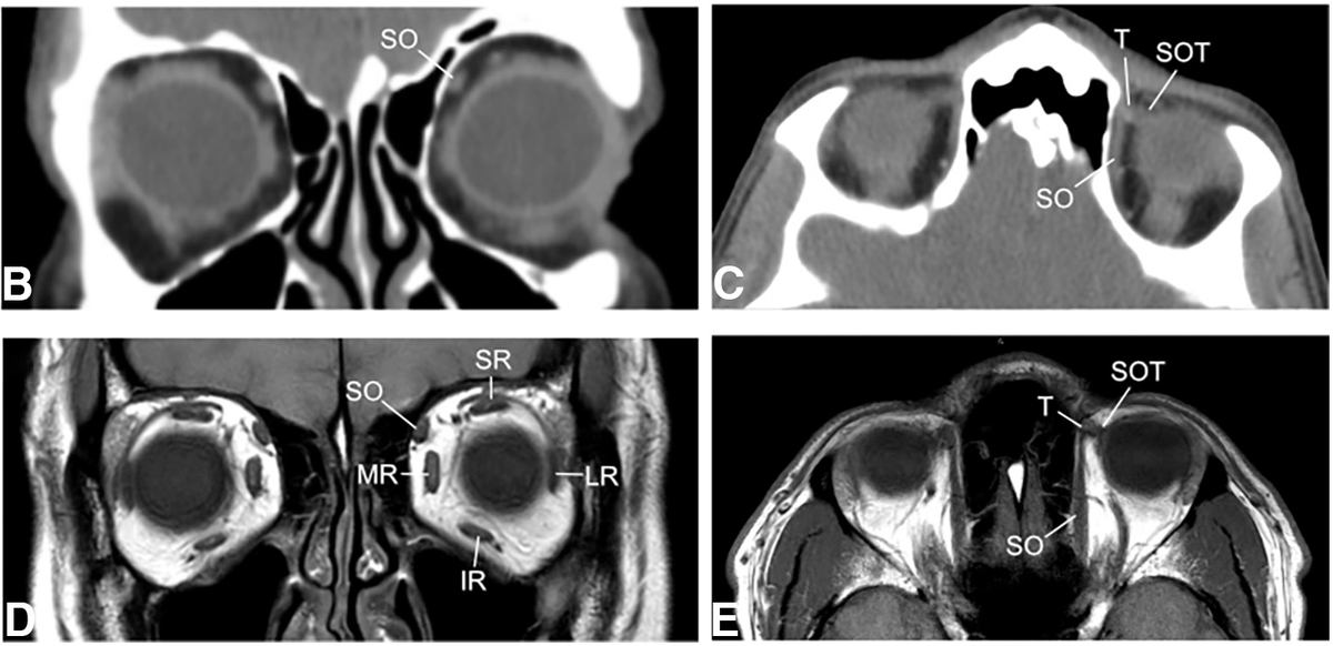 ASNRographics's tweet photo. From the October-December 2023 Issue of #Neurographics: Brown Syndrome or Superior Oblique Tendon Sheath Syndrome: Radiologic Imaging Characteristics and Literature Review https://t.co/7h22GJjI64 https://t.co/5WNQmRZznA