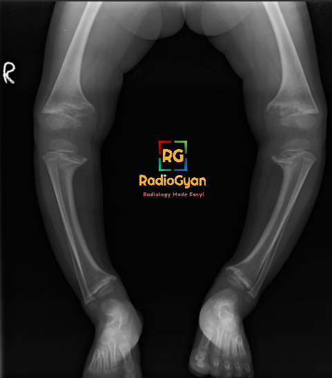 Hx: Child with knee pain. Answer: bit.ly/43gMDAD Case shared by Dr. Vichi Goel MD Radiodiagnosis. #RGcases #radiogyan #radiology #radres #radiologia #FOAMrad #FOAMed