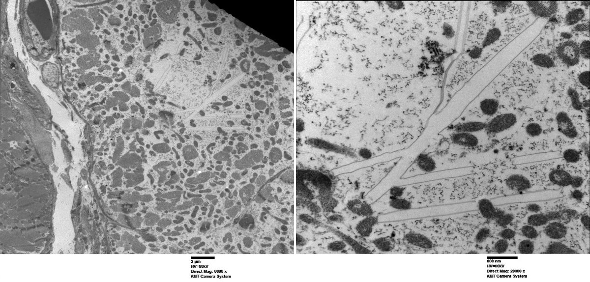 Michael Seidman (@mseidmanmd) on Twitter photo Has anyone ever seen this rod-like breakdown/artifact on EM? <a href="/Marc_Halushka/">Marc Halushka MD PhD</a> <a href="/joemaleszewski/">Joe Maleszewski, MD</a> <a href="/MelanieBoisMD/">Melanie Bois</a> <a href="/SCVP1/">SCVP</a> <a href="/BCRenalPath/">Mei Lin Bissonnette MD PhD FRCPC</a> Has anyone ever seen this rod-like breakdown/artifact on EM? <a href="/Marc_Halushka/">Marc Halushka MD PhD</a> <a href="/joemaleszewski/">Joe Maleszewski, MD</a> <a href="/MelanieBoisMD/">Melanie Bois</a> <a href="/SCVP1/">SCVP</a> <a href="/BCRenalPath/">Mei Lin Bissonnette MD PhD FRCPC</a>