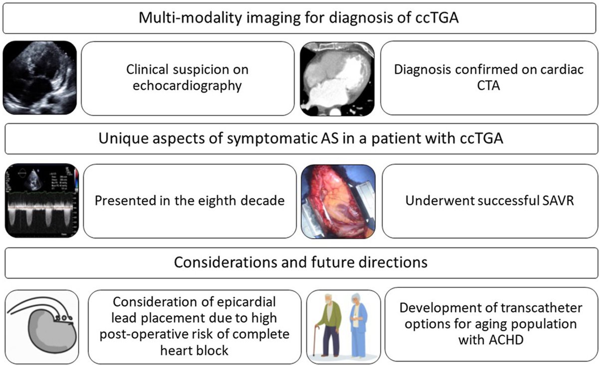 Congenitally corrected transposition of the great arteries (ccTGA), also known as L-transposition of the great arteries, is rare, accounting for 0.5% to 1.4% of congenital heart disease. Read our @CASEfromASE report: bit.ly/43bK96J #CASESpecialIssue #10DaysofCASE #ACHD