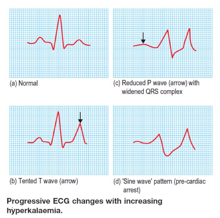 Progressive ECG changes with increasing hyperkalaemia