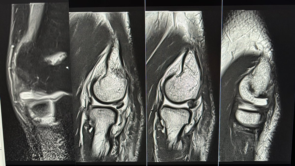 Patient with a history of elbow dislocation and blockages. Intra-articular dislocation of the annular ligament.