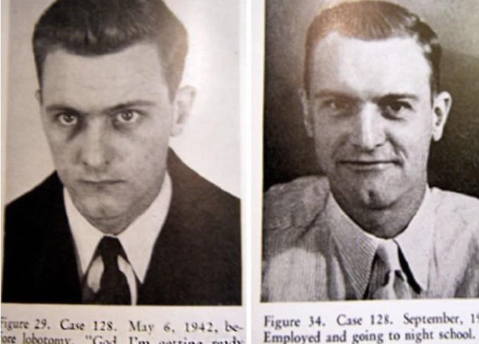 fasc1nate's tweet photo. Picture of a man with Schizophrenia before and after his Lobotomy https://t.co/FYGLblOiMd