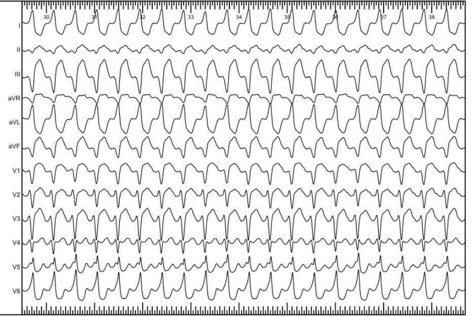 👦🏼 with congenital heart disease: 3 #ECGs within 2 hours. Beauty of #electrophysiology <a href="/EP_Bremen/">Elektrophysiologie Bremen</a> 

<a href="/AGEP_DGK/">AGEP</a> <a href="/YoungDgk/">Young DGK</a> <a href="/syamkumarmd/">Syamkumar</a> <a href="/narrowQRS/">JMC</a> <a href="/bordistef/">Stefano Bordignon, EP</a> <a href="/AG9_DGK/">AG 9 - Kongenitale Herzfehler im Erwachsenenalter</a> <a href="/Dominik_Linz/">Dominik Linz</a> <a href="/ALFIEEP1/">ALBERTO ALFIE</a> <a href="/jeffrey_vinocur/">Jeffrey M Vinocur</a>