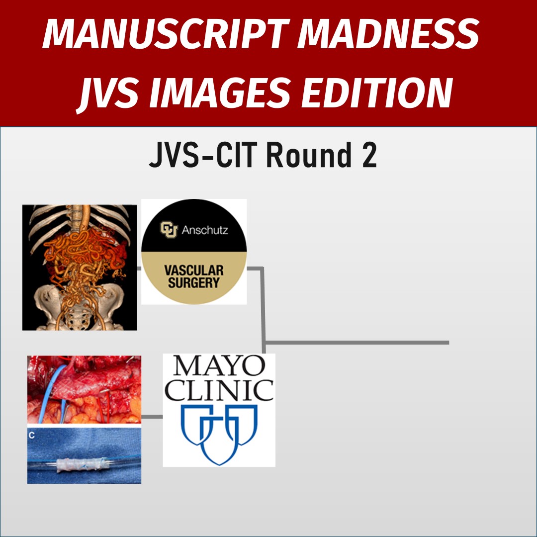 JVS-Cases Innovations and Techniques (@jvascsurgcit) on Twitter photo Round 2 #manuscriptmadness! Check out the manuscripts and stay tuned 4 the polls on Friday! <a href="/CUVascularSurg/">CU Vascular Surgery</a> <a href="/Pedro_FNeves_MD/">Pedro J. Furtado Neves</a> <a href="/RafaMalgor/">Rafael Demarchi Malgor</a> <a href="/MayoClinic/">Mayo Clinic</a> <a href="/randydemartino/">Randall DeMartino</a> <a href="/ArminTabiei/">Armin Tabiei</a> <a href="/limbsalvagedr/">Leigh Ann O'Banion</a> <a href="/mattsmeds/">Matthew Smeds</a> <a href="/drpillado/">Eric Pillado, MD MBA MS</a> <a href="/ProleneQueen/">Meryl Simon Logan, MD</a>
jvscit.org/article/S2468-ā¦
jvscit.org/article/S2468-⦠Round 2 #manuscriptmadness! Check out the manuscripts and stay tuned 4 the polls on Friday! <a href="/CUVascularSurg/">CU Vascular Surgery</a> <a href="/Pedro_FNeves_MD/">Pedro J. Furtado Neves</a> <a href="/RafaMalgor/">Rafael Demarchi Malgor</a> <a href="/MayoClinic/">Mayo Clinic</a> <a href="/randydemartino/">Randall DeMartino</a> <a href="/ArminTabiei/">Armin Tabiei</a> <a href="/limbsalvagedr/">Leigh Ann O'Banion</a> <a href="/mattsmeds/">Matthew Smeds</a> <a href="/drpillado/">Eric Pillado, MD MBA MS</a> <a href="/ProleneQueen/">Meryl Simon Logan, MD</a>
jvscit.org/article/S2468-ā¦
jvscit.org/article/S2468-ā¦