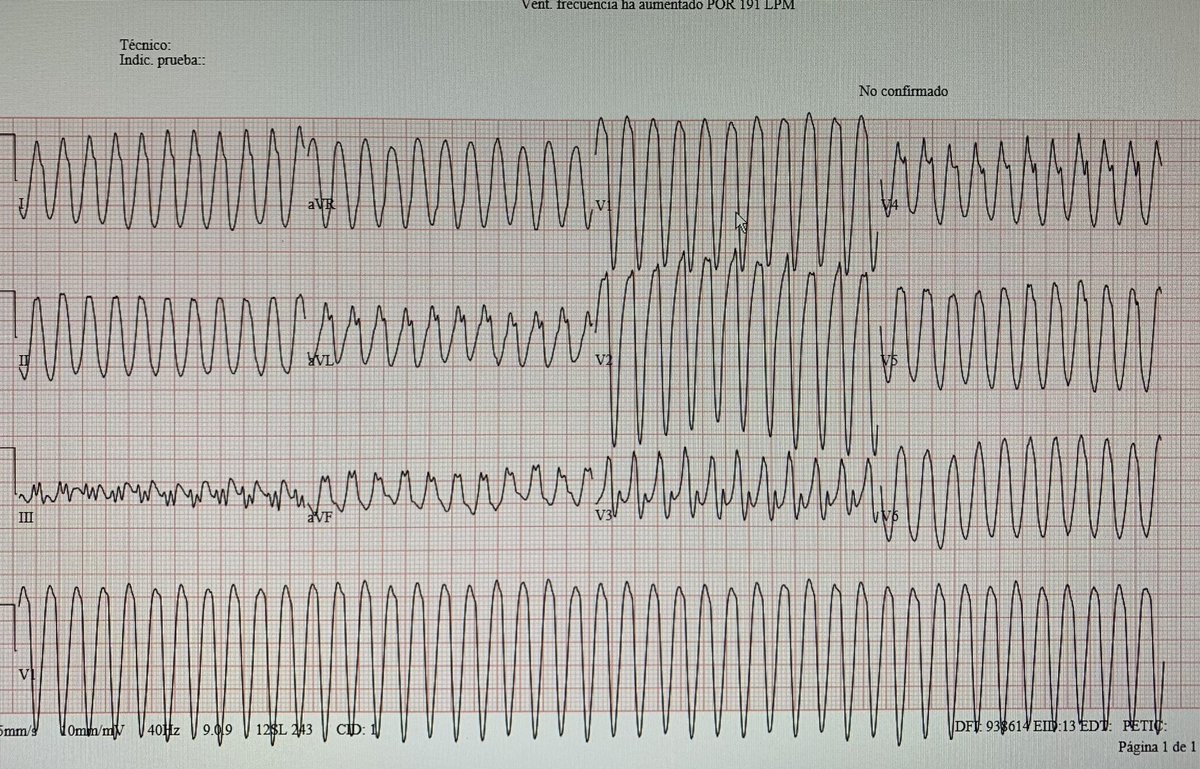 47 y/o Dizziness. Thoughts? #EKG #EPeeps #CardioTwitter #MedTwitter